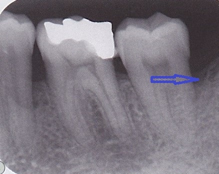 歯周組織再製剤リグロスを使用した骨の再生