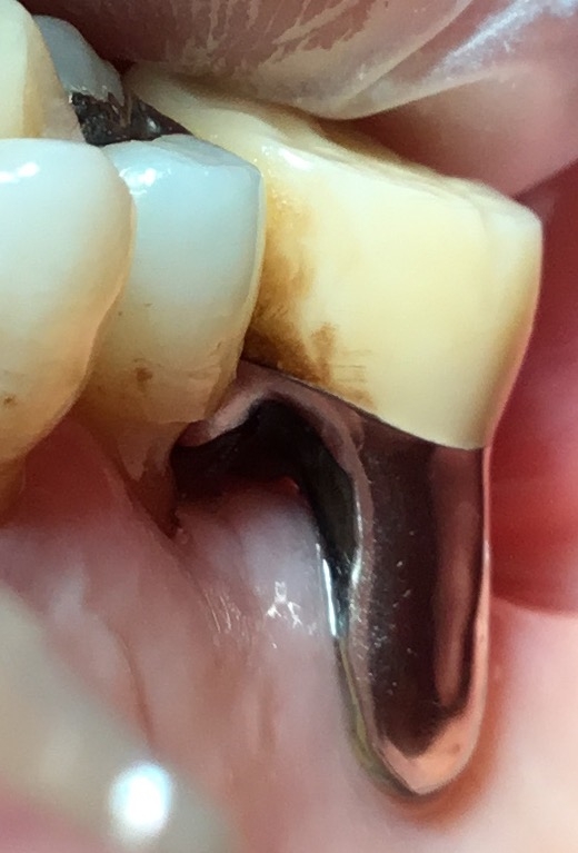 歯周病の大臼歯
