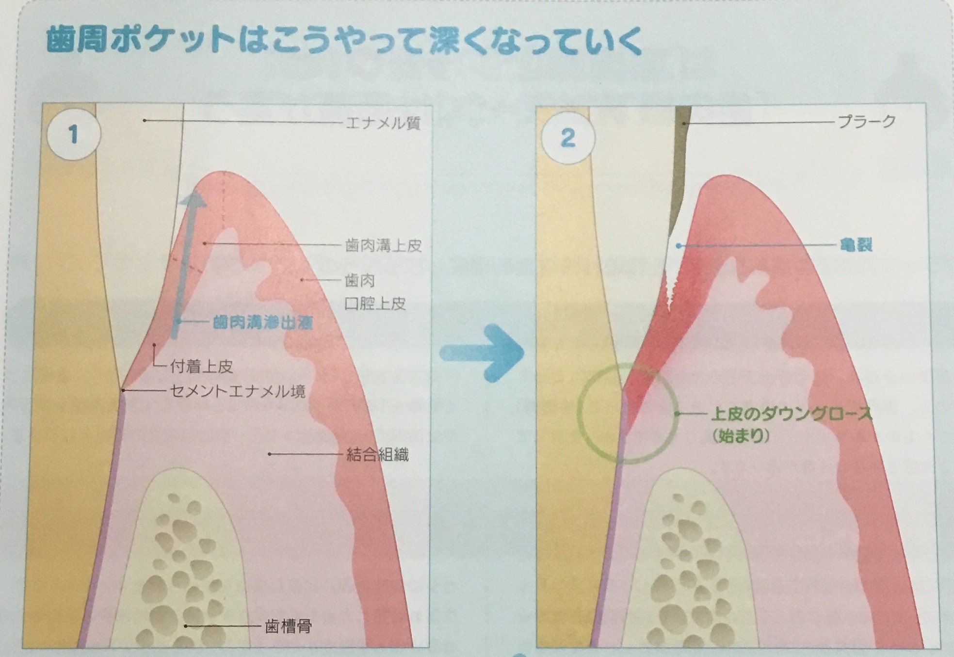 プラークを放っておくと