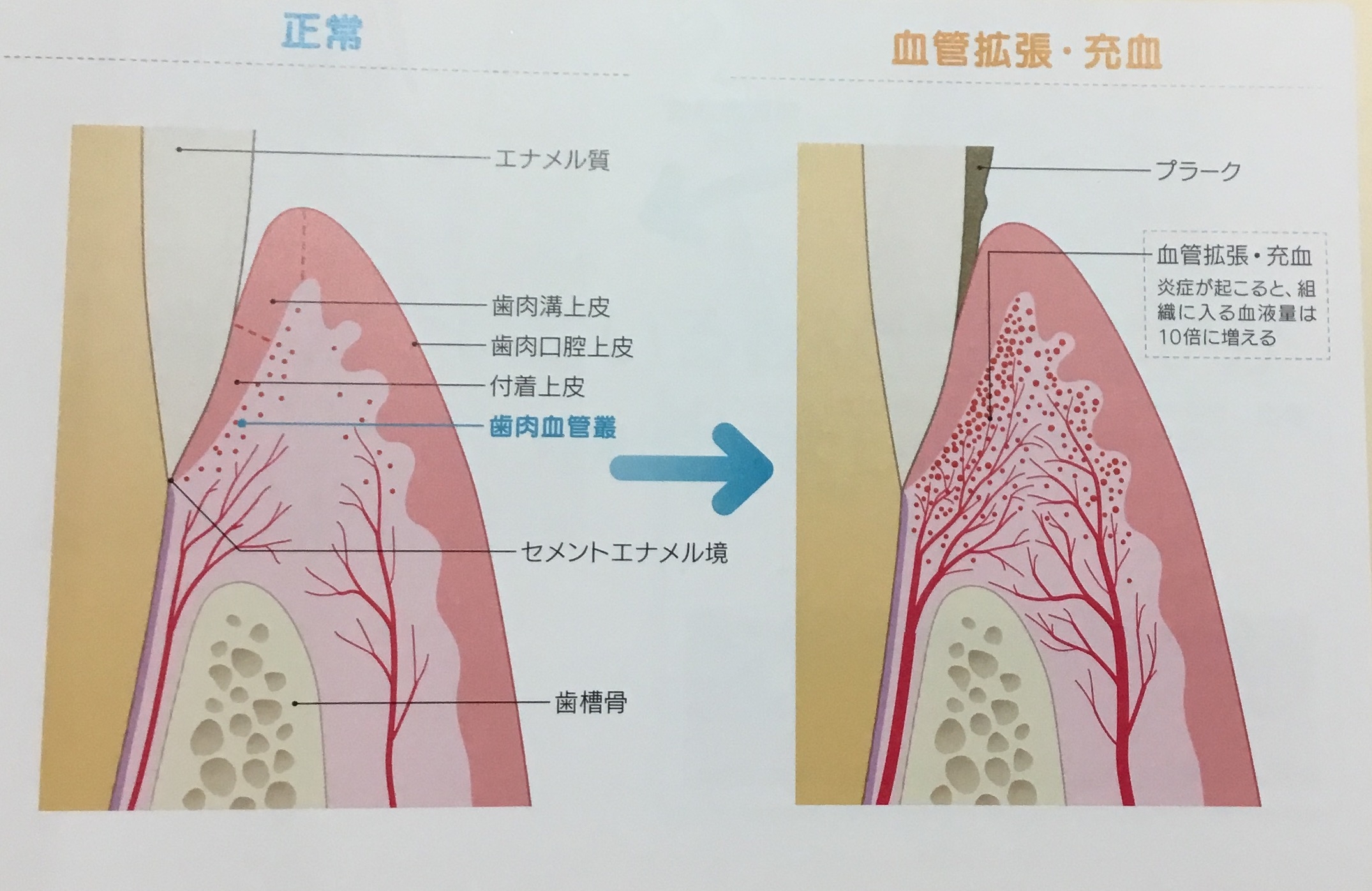 歯肉の発赤