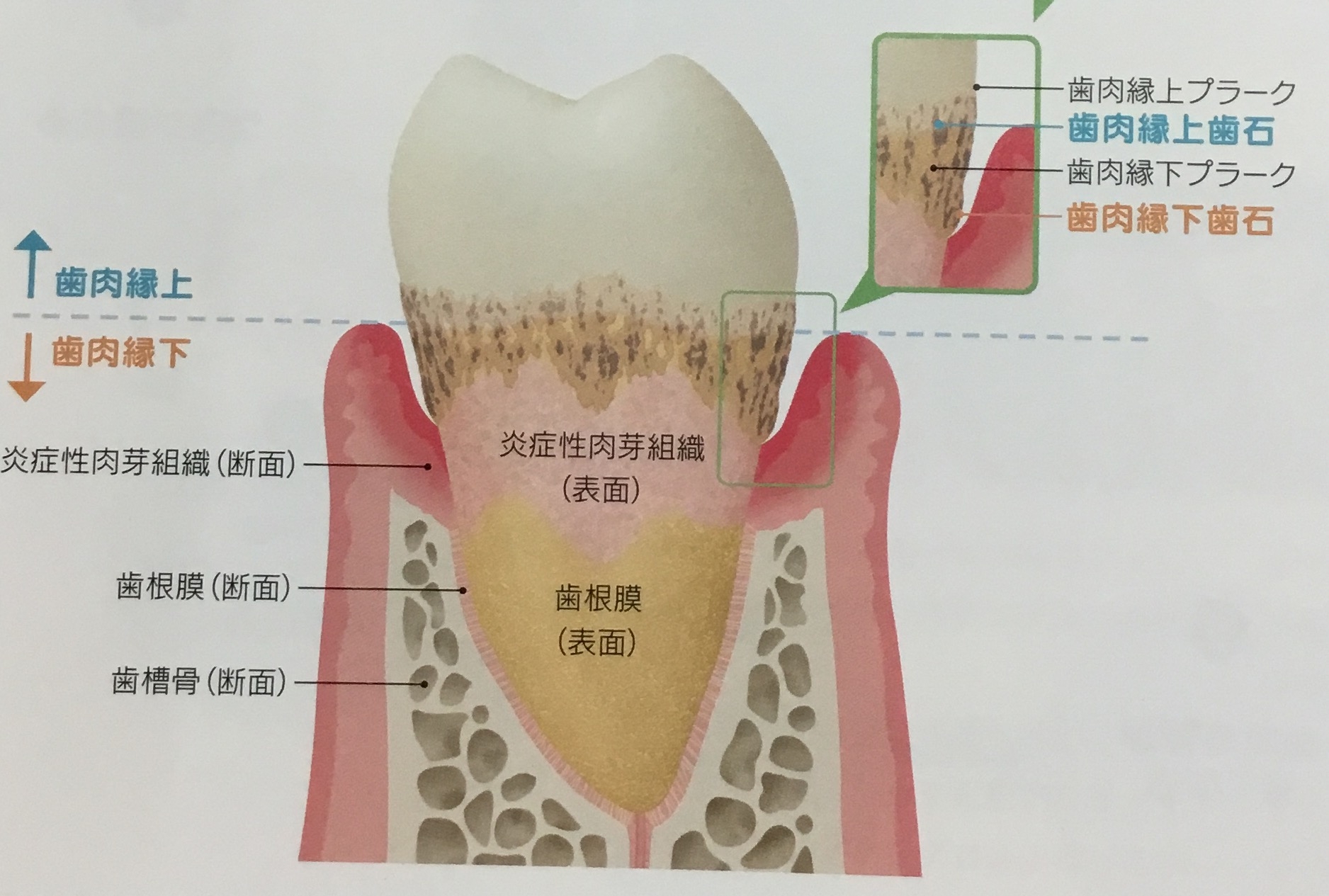 歯石をとる