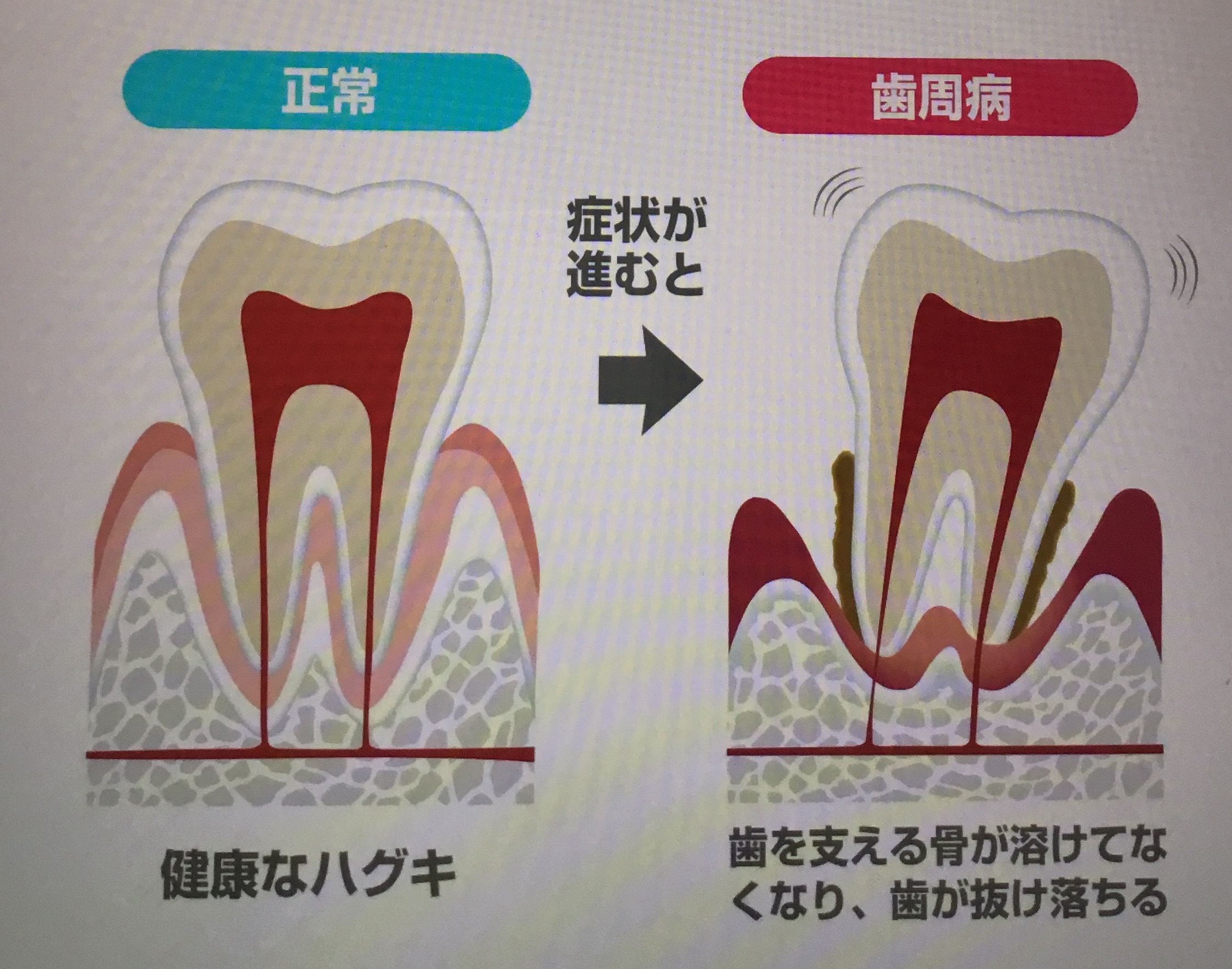 歯を失う前に