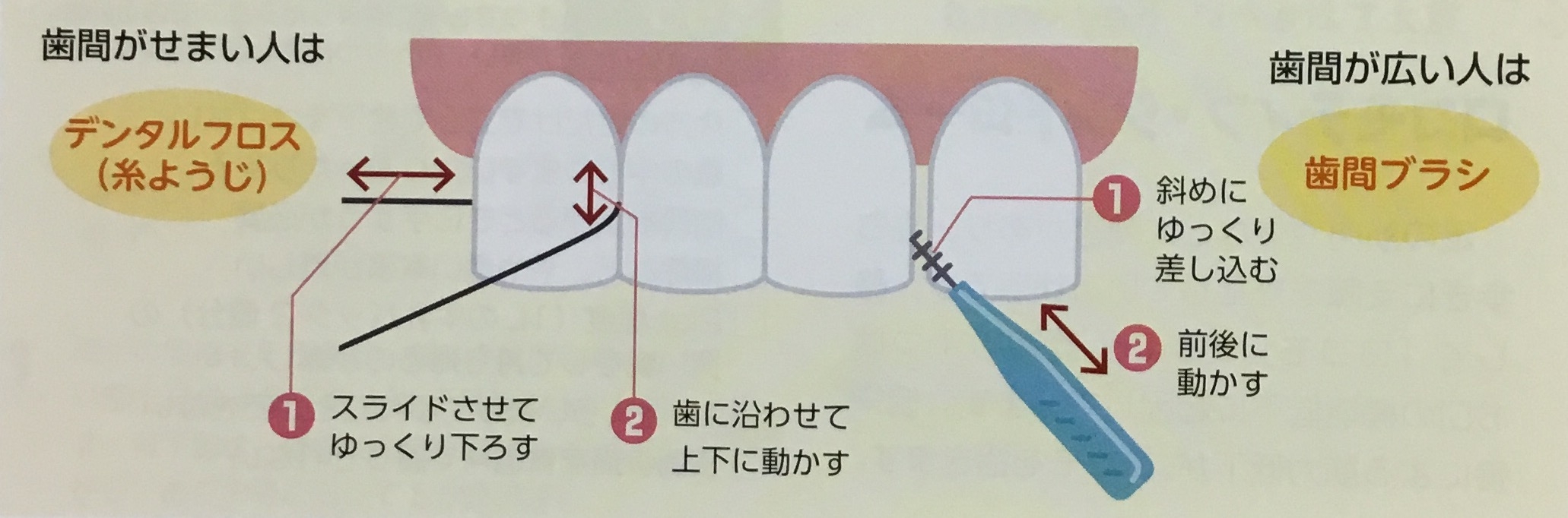 歯間部の根元