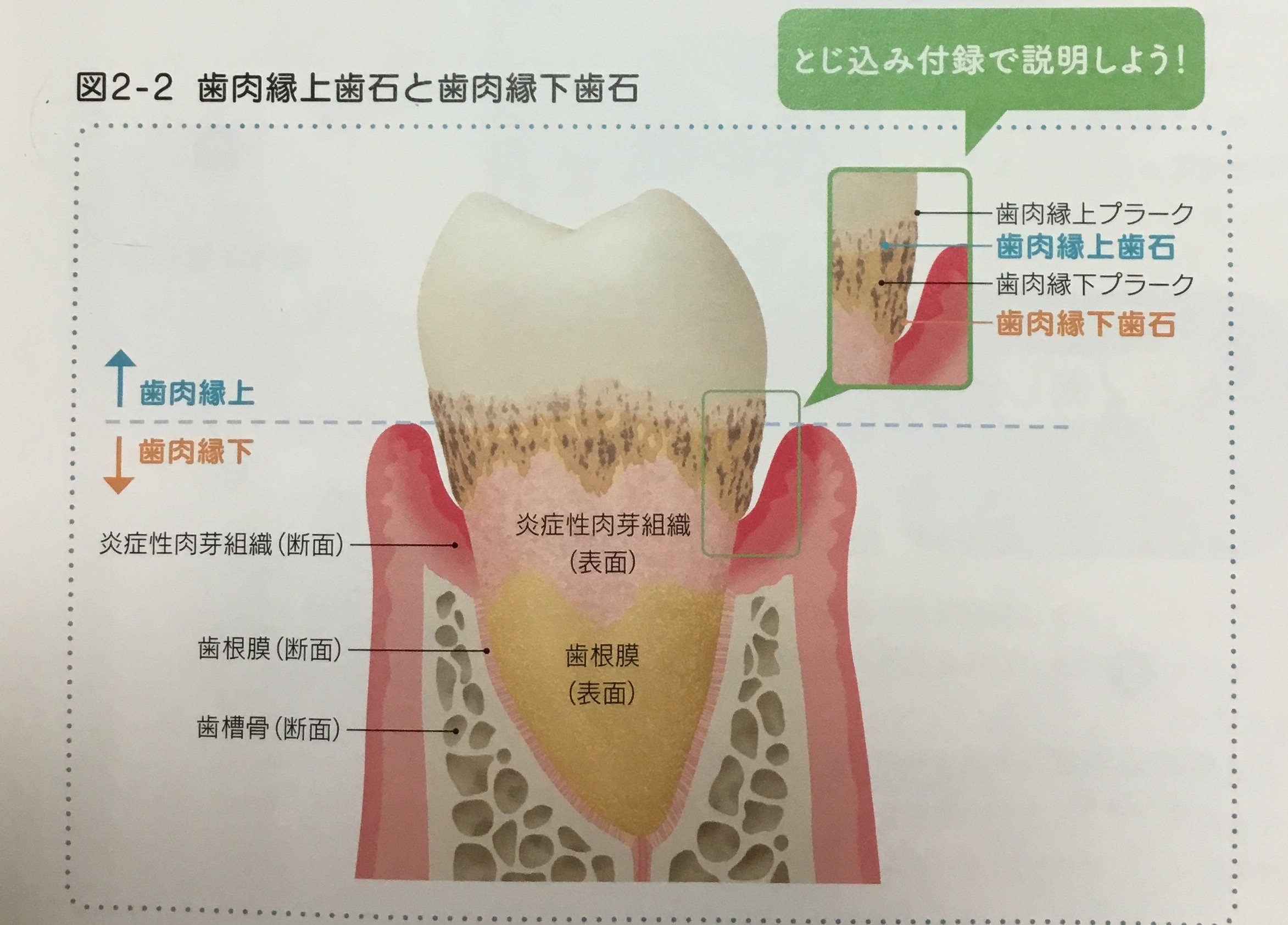 歯石と