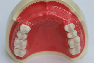 審美義歯の症例