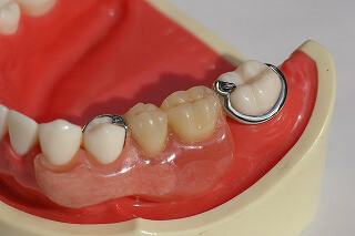 審美義歯の症例