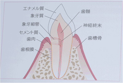 象牙質知覚過敏症