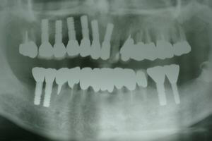 抜歯前のレントゲン写真