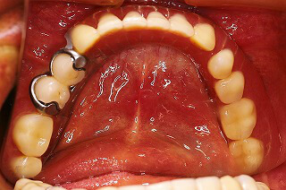 インプラントの上部構造上に下顎義歯を装着した口腔内写真
