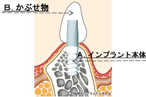 インプラント費用のしくみ
