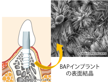 特許技術を駆使した最先端のインプラント体のみを使用