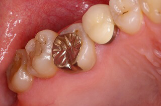 軽度歯周病の症例